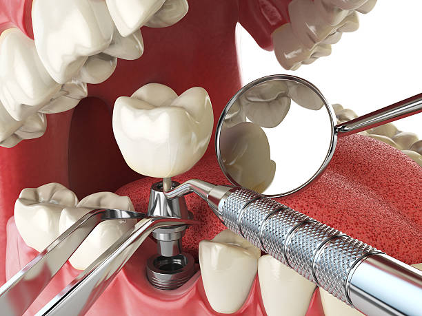 Best Emergency Wisdom Tooth Extraction in La Vernia, TX